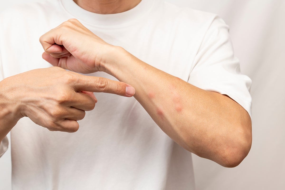 alergia uczulenie na komary