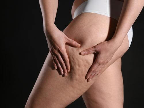 Cellulit tłuszczowy - co to jest? Jak powstaje?